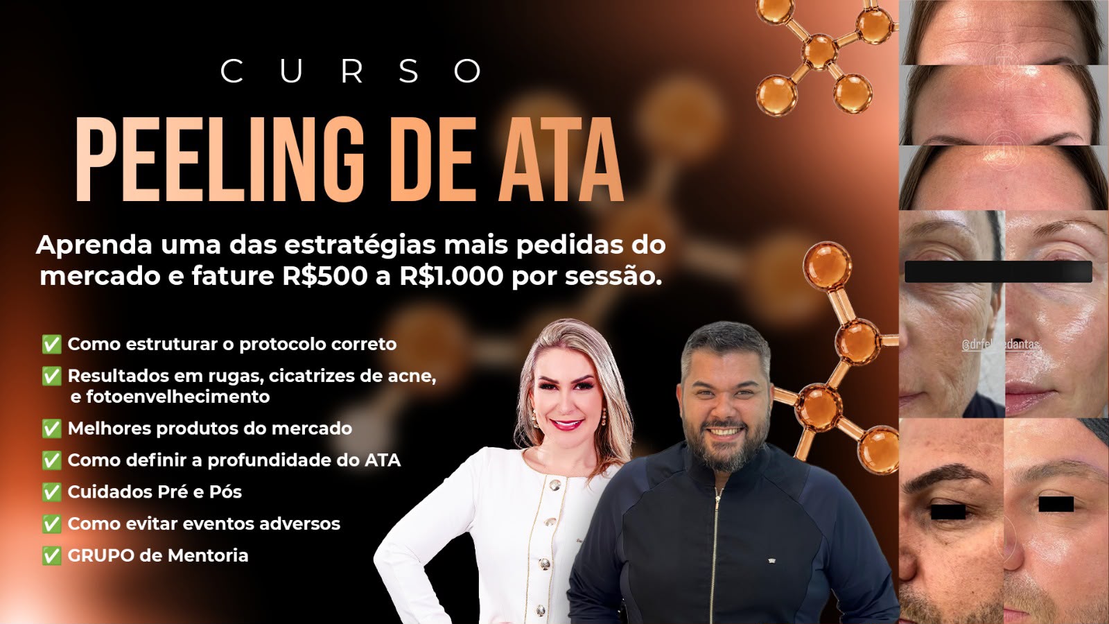 Curso Peeling de ATA com especialistas e resultados de rejuvenescimento