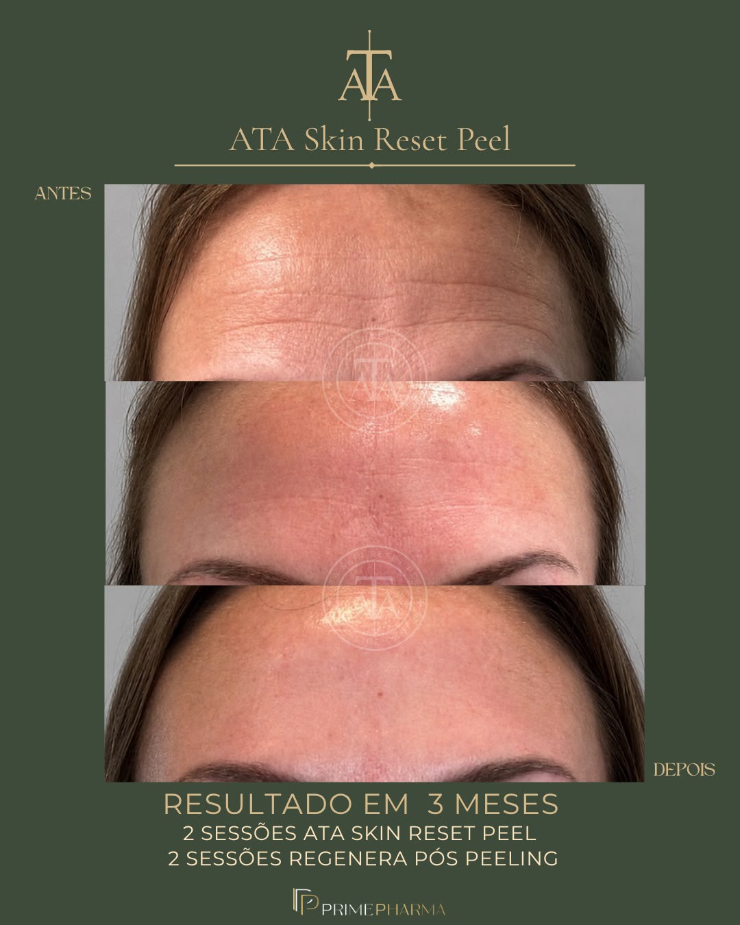 Resultado em 3 meses com ATA Skin Reset Peel